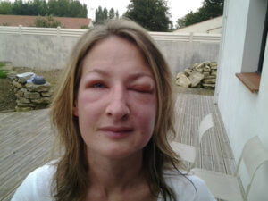 Photo de la jeune femme victime de l’attaque de frelon asiatique en Vendée