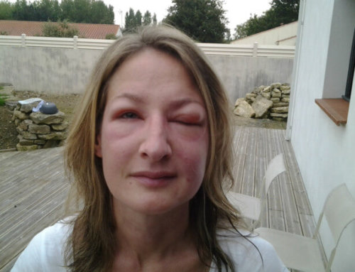 Attaque de frelons asiatiques en Vendée